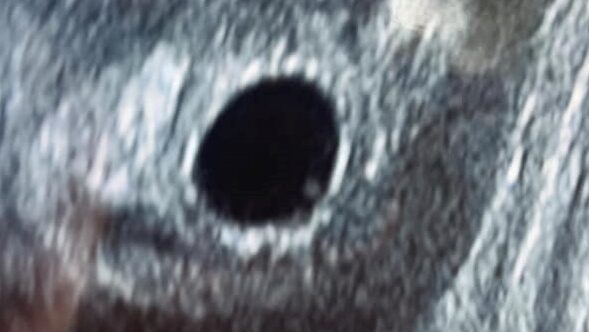 Ultrasound image of a gestational sac at 5 weeks of pregnancy, indicating early embryo development for pregnancy viability scan.